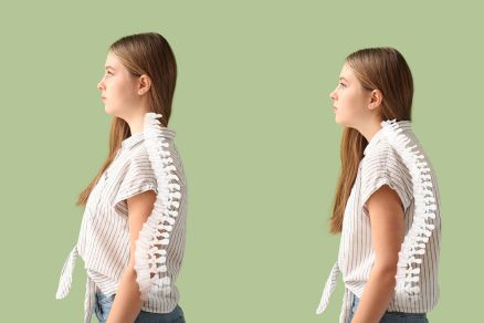 Scoliosis