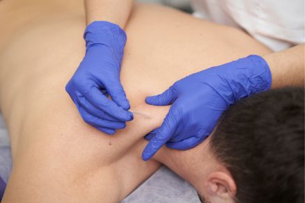 Professional doing Dry Needling on shoulder