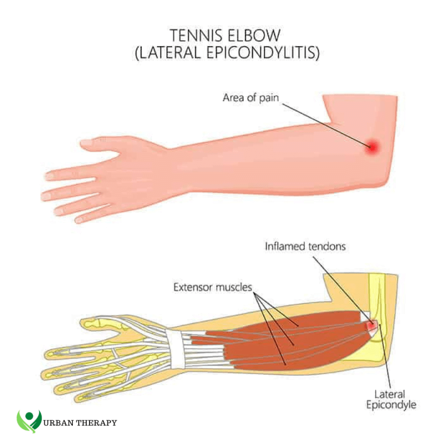 Tennis Elbow